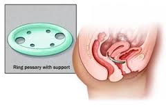 e. Pessary - an orthotic device which is designed to lift the pelvic floor muscles, connective tissue and ligaments.