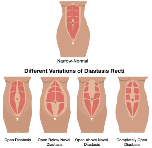 diastasis_recti_illustration3.png